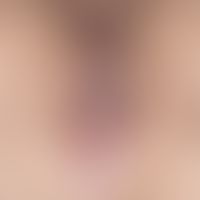 Lichen sclerosus with perianal infestation, vulva free, typical is the scahrf limited marginal zo...