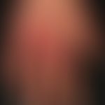 Drug reaction fixe: multilocular FA with incipient epidermolysis on sharply defined plaques on th...