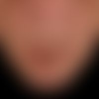 Karzinom der Haut: seit Jahren bestehendes, kontinueirlich wachsendes Lippenkarzinom.
