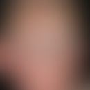 Impetigo contagiosa: extensive, weeping and encrusted red plaques in an infant with previously kn...