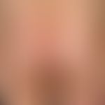Atopisches Ekzem im Kindes-/Jugendalter: 12Jahre alter Jugendlicher&nbsp;mit vorbekanntem atopisc...