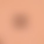 Naevus Spitz: reflected light microscopic image with a homogeneous, black-brown centre and numero...