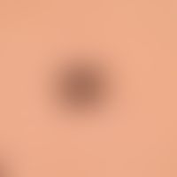 Naevus Spitz: reflected light microscopic image with a homogeneous, black-brown centre and numero...