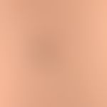 Naevus Spitz: slightly raised, irregularly bordered, black-brown neoplasm, existing for several m...