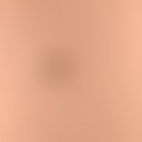 Naevus Spitz: slightly raised, irregularly bordered, black-brown neoplasm, existing for several m...