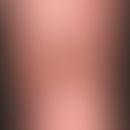 Ulcus cruris arteriosum: chronic, slowly progressive, painful, deep, sharp-edged ulcer located in...