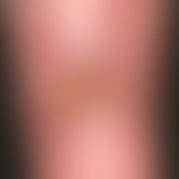 Ulcus cruris arteriosum:&nbsp;chronisches, langsam progredientes, schmerzhaftes, im Bereich des U...