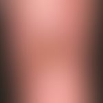 Ulcus cruris arteriosum:&nbsp;chronisches, langsam progredientes, schmerzhaftes, im Bereich des U...