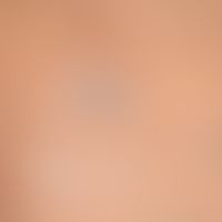 Melanoma malignes: Melanoma metastases with halo-like depigmentation of the overlying skin; blue ...