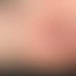 Melanom malignes amelanotisches: seit frühester Kindheit sei ein Pigmentmal an dieser Stelle beka...