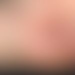 Melanom malignes amelanotisches: seit frühester Kindheit sei ein Pigmentmal an dieser Stelle beka...