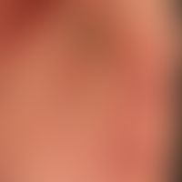 Mycosis fungoides tumor stage: for years, previously known mycosis fungoides; for about several m...