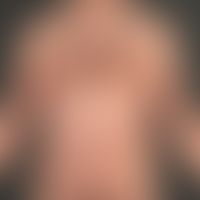 Mycosis fungoides (Plaque-Stadium):&nbsp;62-jähriger Mann (Sog. Plaquestadium der Mycosis fungoid...