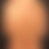 Circumscribed scleroderma (plaque-type):  Survey image of the back: size-progressive, large, brow...