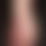 Malformationen vaskuläre: Naevus flammeus (kapilläre/venöse Malformation) ohne&nbsp; Weichteilhyp...
