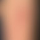 Malformationen vaskuläre:&nbsp;Nicht-syndromale kapilläre Malformation&nbsp;(Naevus flammeus/Port...