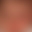 Naevus flammeus (port wine stain): congenital erythema in the facial region (capillary vascular m...