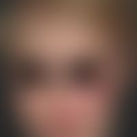 Naevus flammeus (Port wine stain):&nbsp;kongenitale, in V2-Verteilung lokalisierte,&nbsp;völlig s...