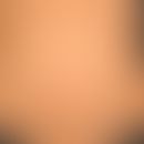 Disseminierte&nbsp;braune Flecken. Hier "Café au lait"-Flecken bei peripherer (TypI-) Neurofibrom...