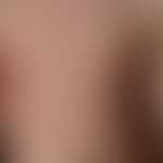 Neurofibromatosis peripheral: Multiple dermal and large subcutaneous neurofibromas. Large café au...