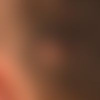 Neurofibrom: seit Jahren bekanntes, langsam wachsendes, diffuses Neurofibrom. Keine Anhalt für ei...