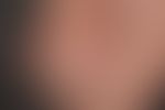 Onychophagie: Nageldystrophei durch ständiges Nagelbeißen.&nbsp;
