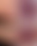 Nagelhämatom: "herauswachsendes" Nagelhämatom. Wichtige Differenzialdiagnose zum subungualen mali...