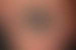Älteres Nagelhämatom:&nbsp; tiefschwarze Verfärbung der Nagelplatte. Verfärbung des Nagelhäutchen...