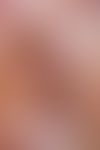Nagelhämatom:&nbsp;streifiges frisches Nagelhämatom, Auflichtmikroskopie&nbsp;
