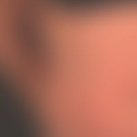 Netherton Syndrome: clinical picture already manifested in childhood with the formation of large,...