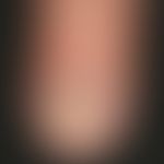 Onychodystrophy: Longitudinal fragmentation of the nail with leaf-like destruction of the nail pl...