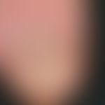 Eczema nail: massive chronic onychdystrophy with irregular thickening of the nail plate and deep ...