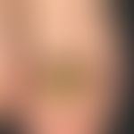 Onychogrypose: Schwere traumatisch induzierte (Fußballspieler) Onychogrypose.&nbsp;
