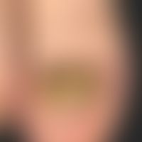 Onychogrypose: Schwere traumatisch induzierte (Fußballspieler) Onychogrypose.&nbsp;
