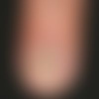 Onychorrhexis:&nbsp;blätterteigartige&nbsp;Ausplitterung der&nbsp;Nagelmatrix.

