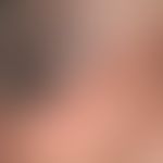 Melanose transiente neonatale pustulöse: mulitple frische Pusteln bei einem Neueborenen.
