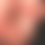 Acute paronychia: Massive purulent paronychia with superimposed weeping crusts; red swollen nail ...
