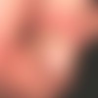 Paronychie akute: maassive eitrige Paronychie mit überlagernden nässenden Krusten. Hochrot geschw...