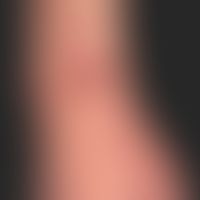 Ekthyma:&nbsp;multiple, an beiden Unterarmen und &nbsp;Handrücken &nbsp;akut aufgetretene, schmer...