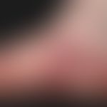 Pustulose akute generalisierte exanthematische: Detailaufnahme des Fußes. &nbsp;Neben kleinherdig...