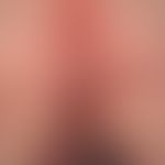 Pemphigoid bullöses:&nbsp;generalisiertes Krankheitsbild. Flächenhafter perianaler &nbsp;Befall m...