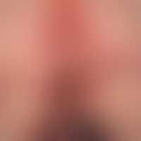 Pemphigoid bullöses:&nbsp;generalisiertes Krankheitsbild. Flächenhafter perianaler &nbsp;Befall m...