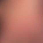 Pemphigoid&nbsp;bullöses: multiple&nbsp;pralle&nbsp;Blasen mit gelblichem und hämorrhagischem Bla...