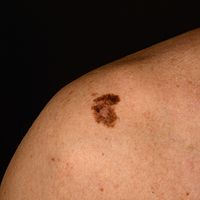 melanotic freckle of hutchinson Lentigo maligna - Altmeyers Encyclopedia mountainor Buy More Save More:One Bottle Nutricost Acetyl L-Carnitine -
