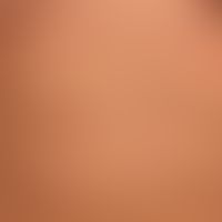 Urticaria pigmentosa: general view: about 0.5-1.0cm large, disseminated, oval or round, brownish-...