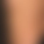 Urticaria pigmentosa: general view: about 0.5-1.0cm large, disseminated, oval or round, brownish-...