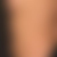 Urticaria pigmentosa: general view: about 0.5-1.0cm large, disseminated, oval or round, brownish-...