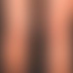 Acute urticaria: acutely occurring, itchy exanthema with roundish, also anular wheals; distinct h...