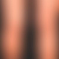 Acute urticaria: acutely occurring, itchy exanthema with roundish, also anular wheals; distinct h...