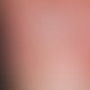 Onychodystrophy: apparently single damage (local event because transverse grooves are formed only...